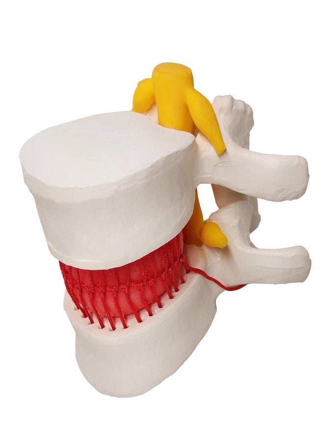 EVOTECH SCIENTIFIC Human Herniated Disc Model, Anatomical Herniated Lumbar Vertebrae Disc Prolapse Model for Medical Teaching Learning, Education Display Tooling, Student Learning Education Display Tool 3 Pack - Image 3